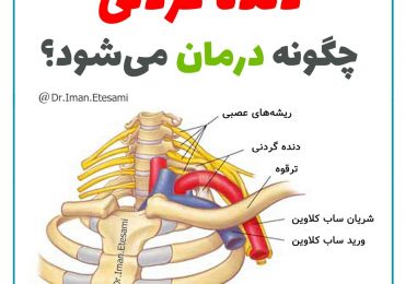 دنده گردنی چگونه درمان می‌شود؟
